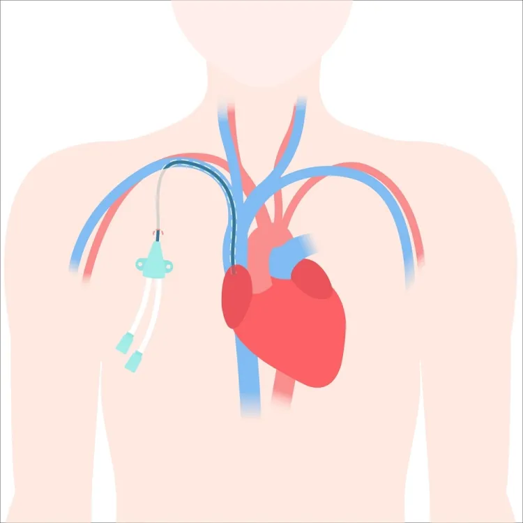 علاج التهاب قسطرة غسيل الكلى